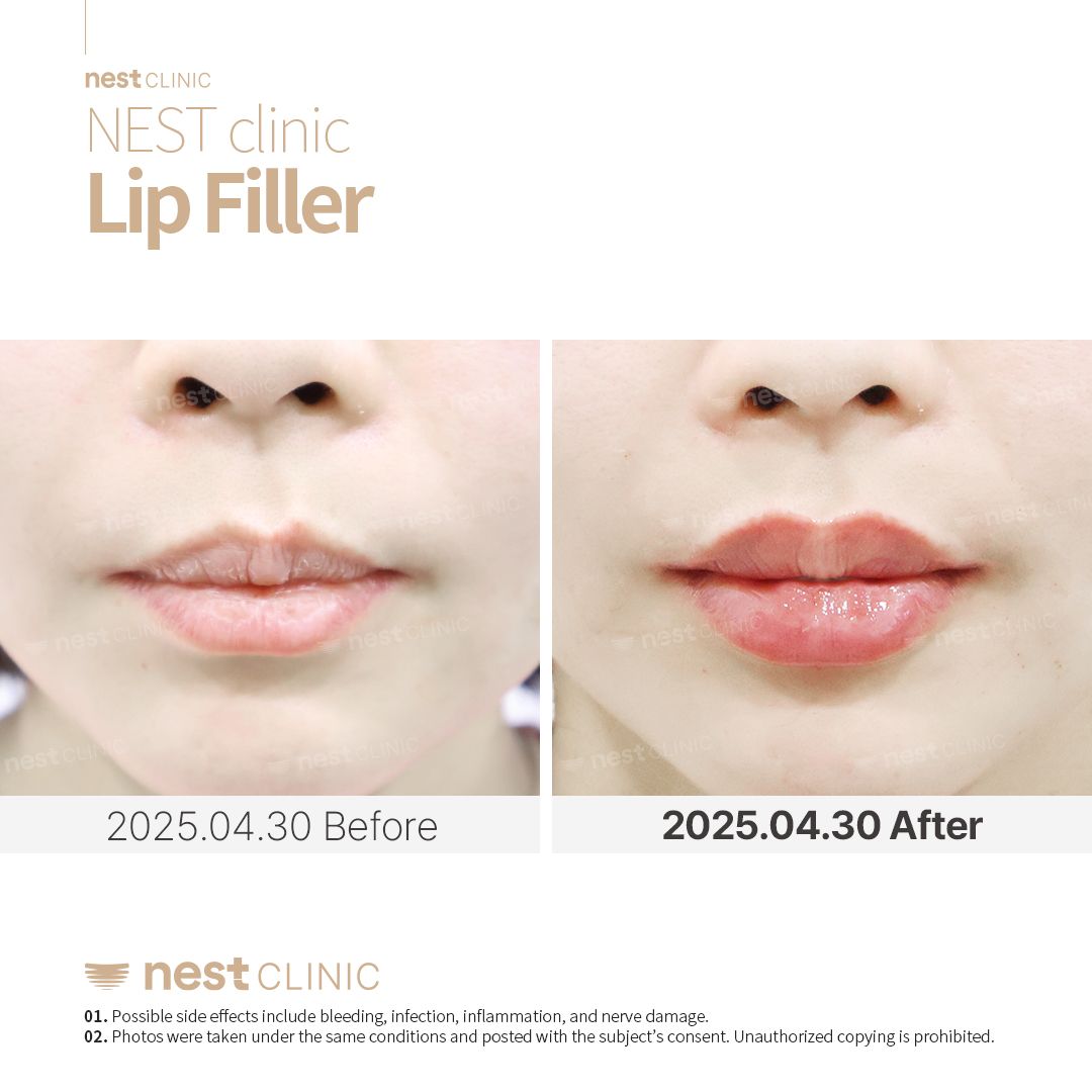 Lip Filler before and after — Nest Clinic Gangnam, patient 7