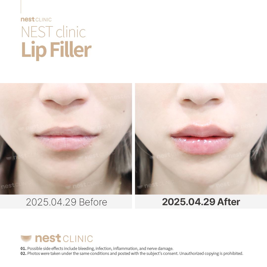 Lip Filler before and after — Nest Clinic Gangnam, patient 6