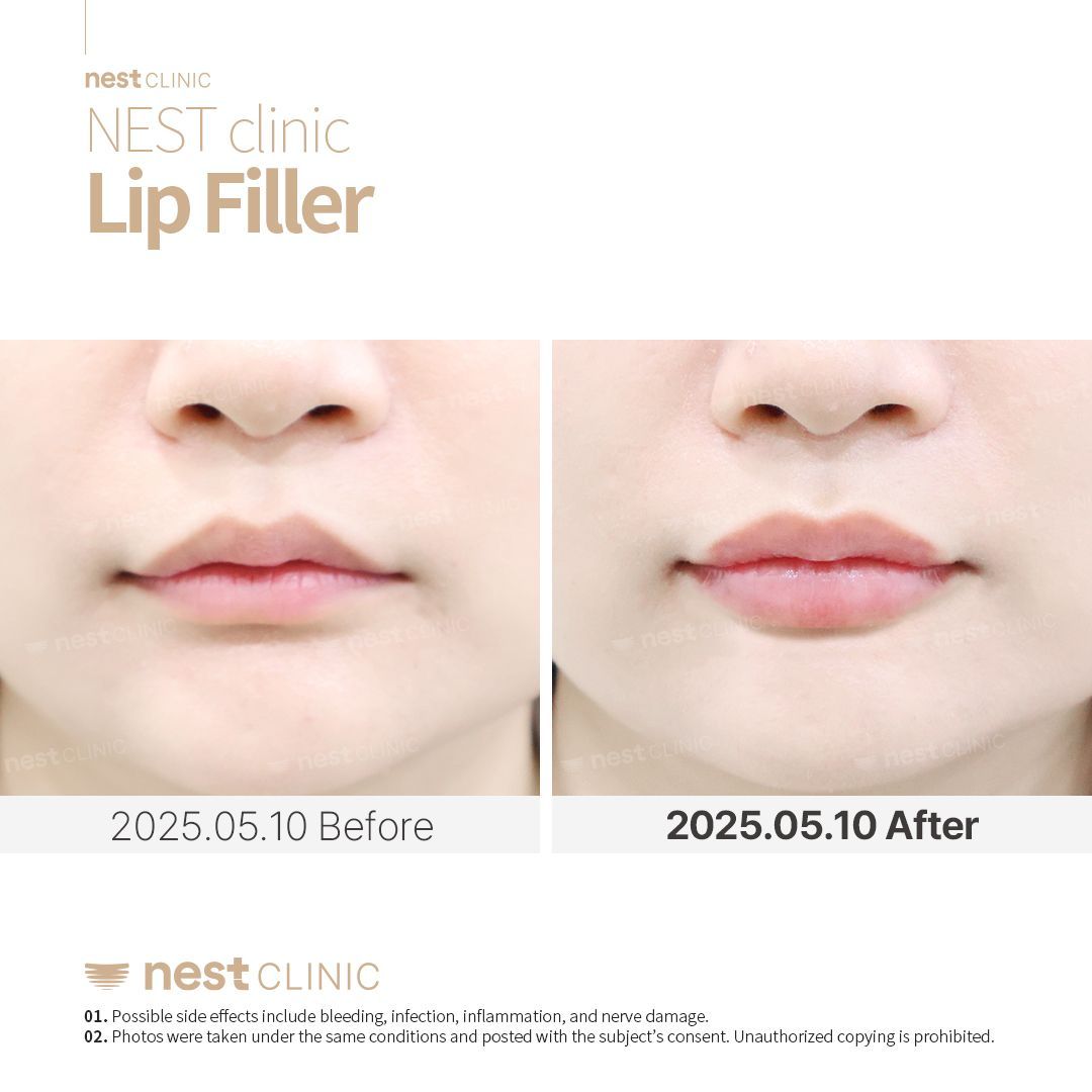 Lip Filler before and after — Nest Clinic Gangnam, patient 4