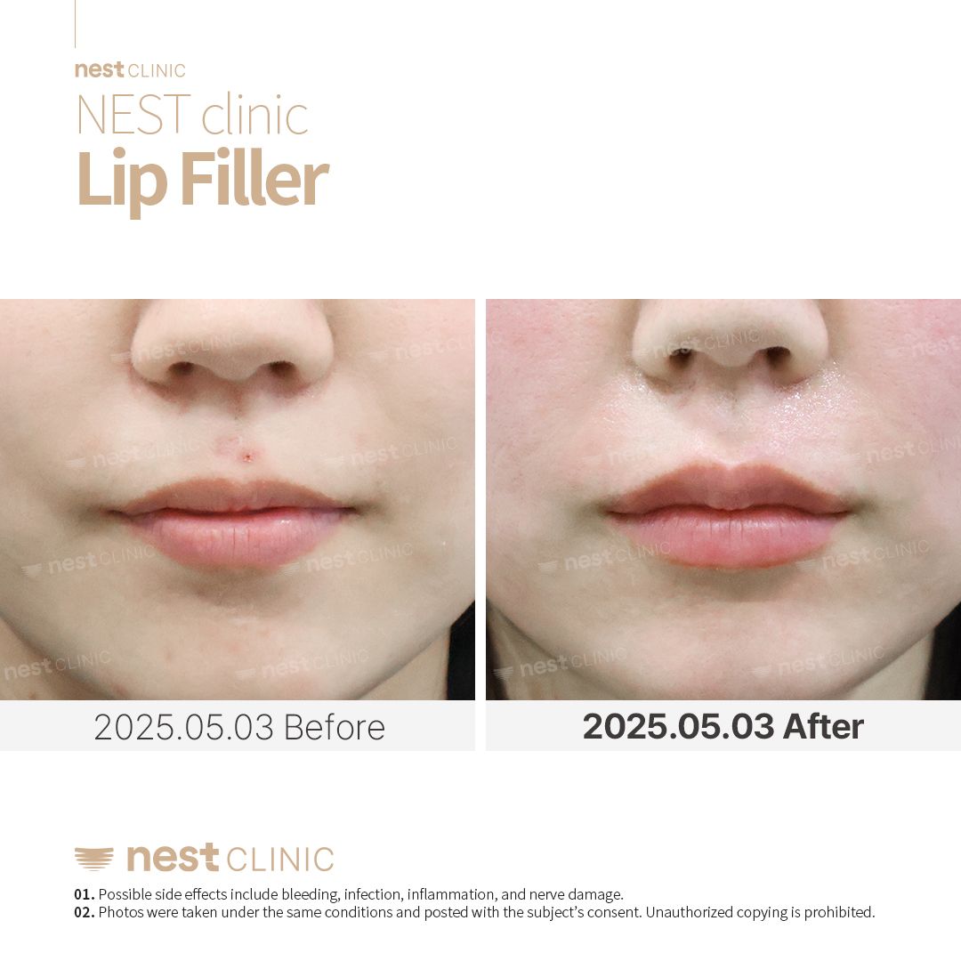 Lip Filler before and after — Nest Clinic Gangnam, patient 5
