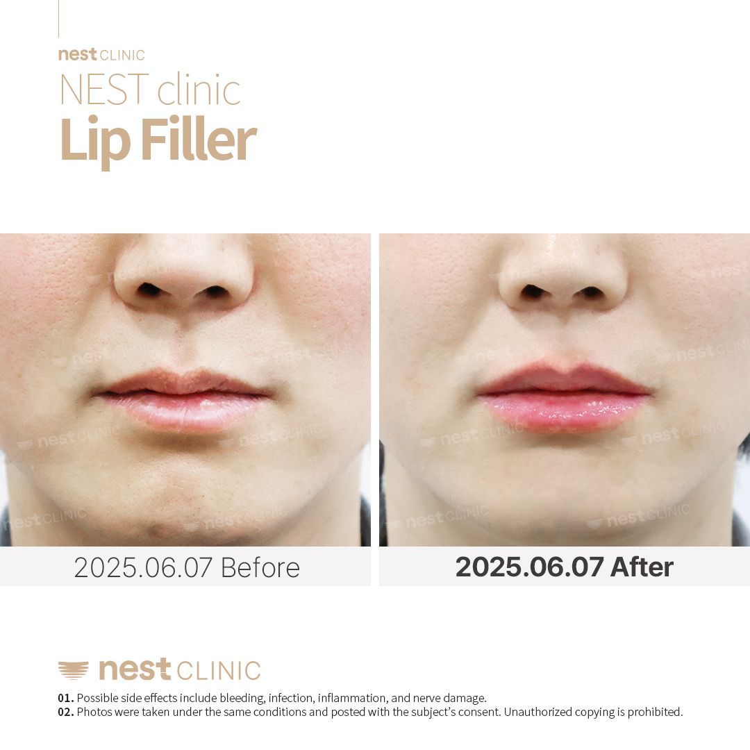 Lip Filler before and after — Nest Clinic Gangnam, patient 3