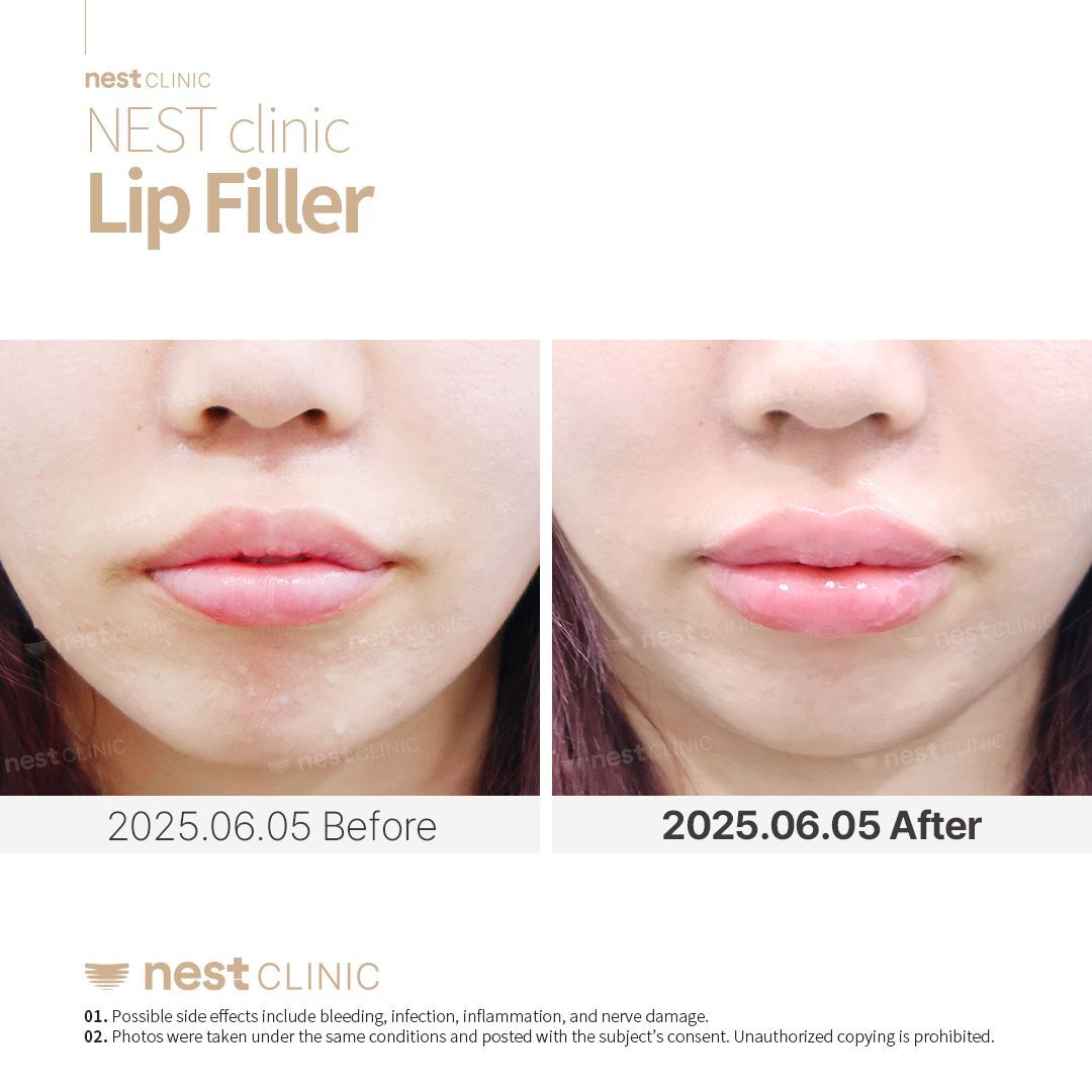 Lip Filler before and after — Nest Clinic Gangnam, patient 2