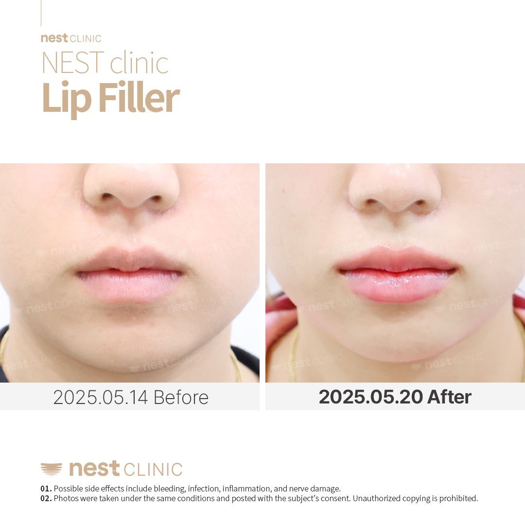 Lip Filler — Nest Clinic Gangnam