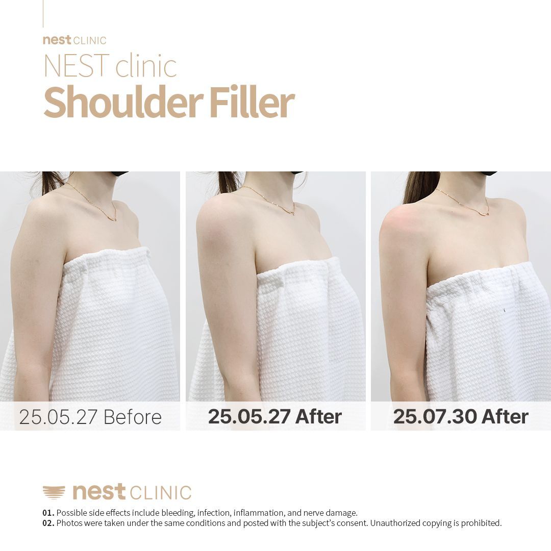 Shoulder Filler before and after — Nest Clinic Gangnam, patient 22