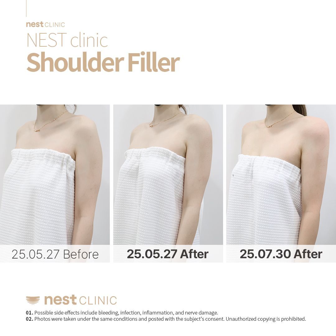 Shoulder Filler before and after — Nest Clinic Gangnam, patient 20