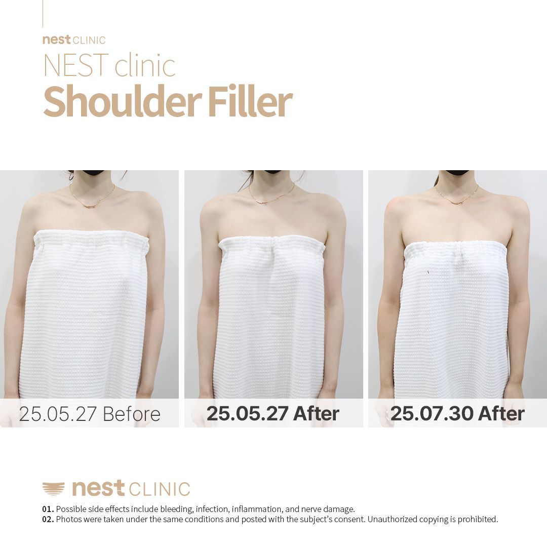 Shoulder Filler before and after — Nest Clinic Gangnam, patient 21