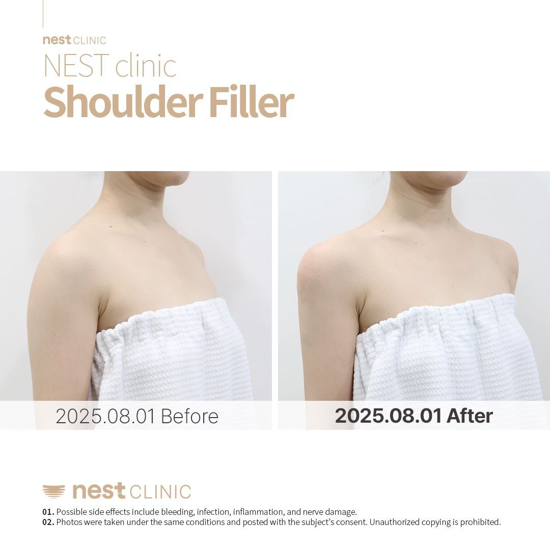 Shoulder Filler before and after — Nest Clinic Gangnam, patient 16