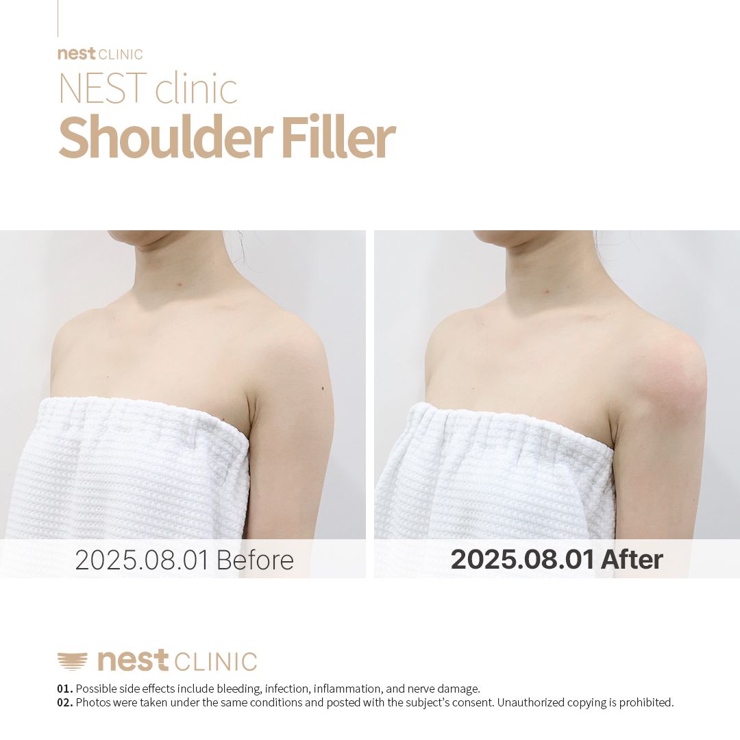 Shoulder Filler before and after — Nest Clinic Gangnam, patient 17