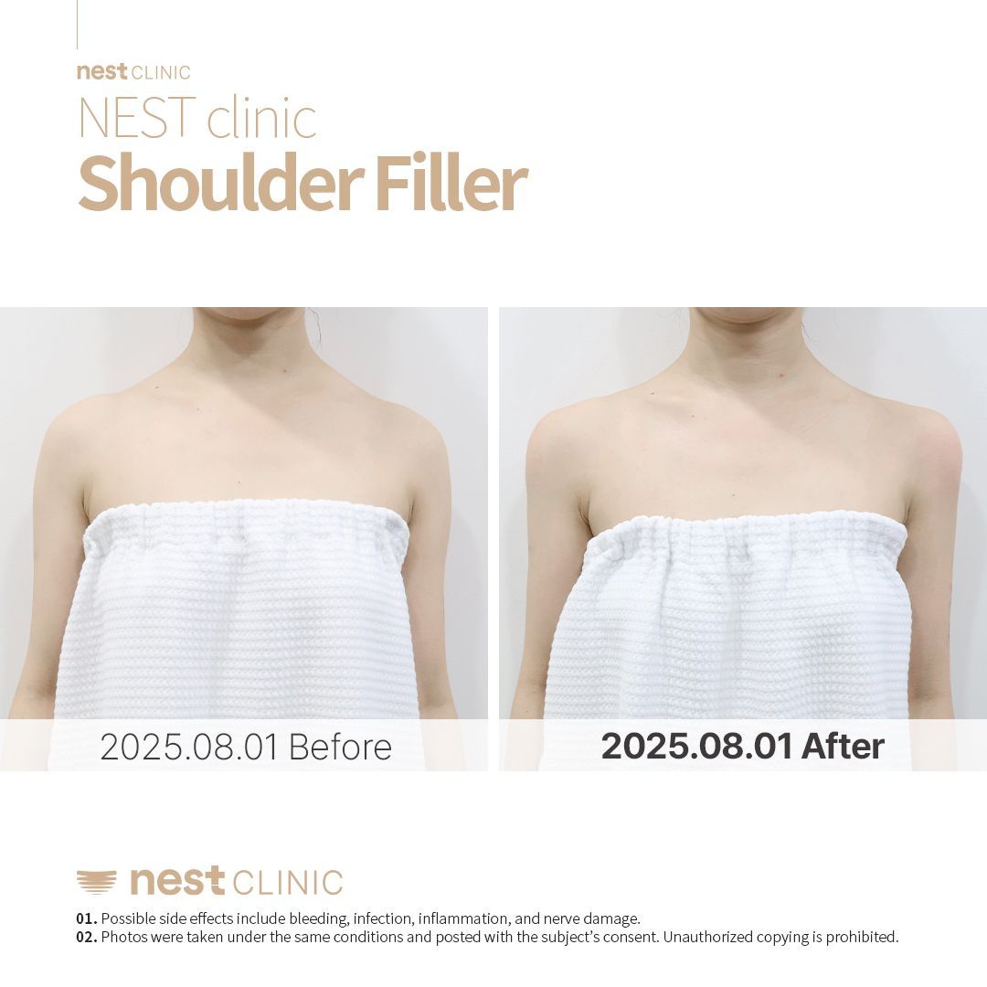 Shoulder Filler before and after — Nest Clinic Gangnam, patient 18
