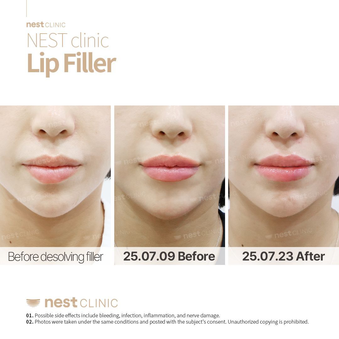 Lip Filler before and after — Nest Clinic Gangnam, patient 15