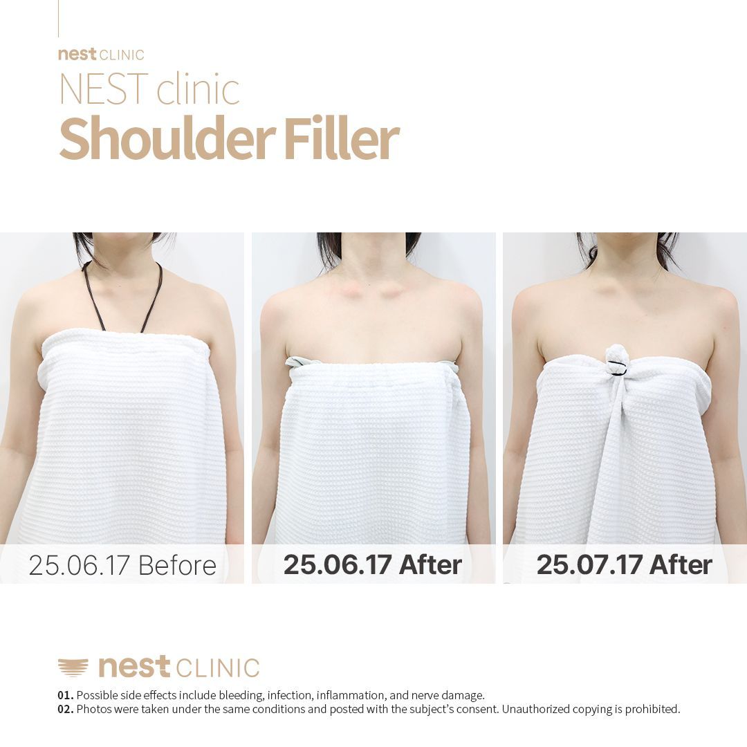 Shoulder Filler before and after — Nest Clinic Gangnam, patient 24