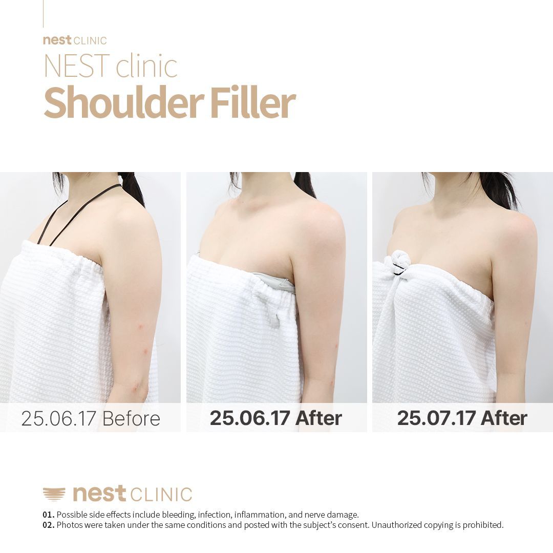 Shoulder Filler before and after — Nest Clinic Gangnam, patient 25