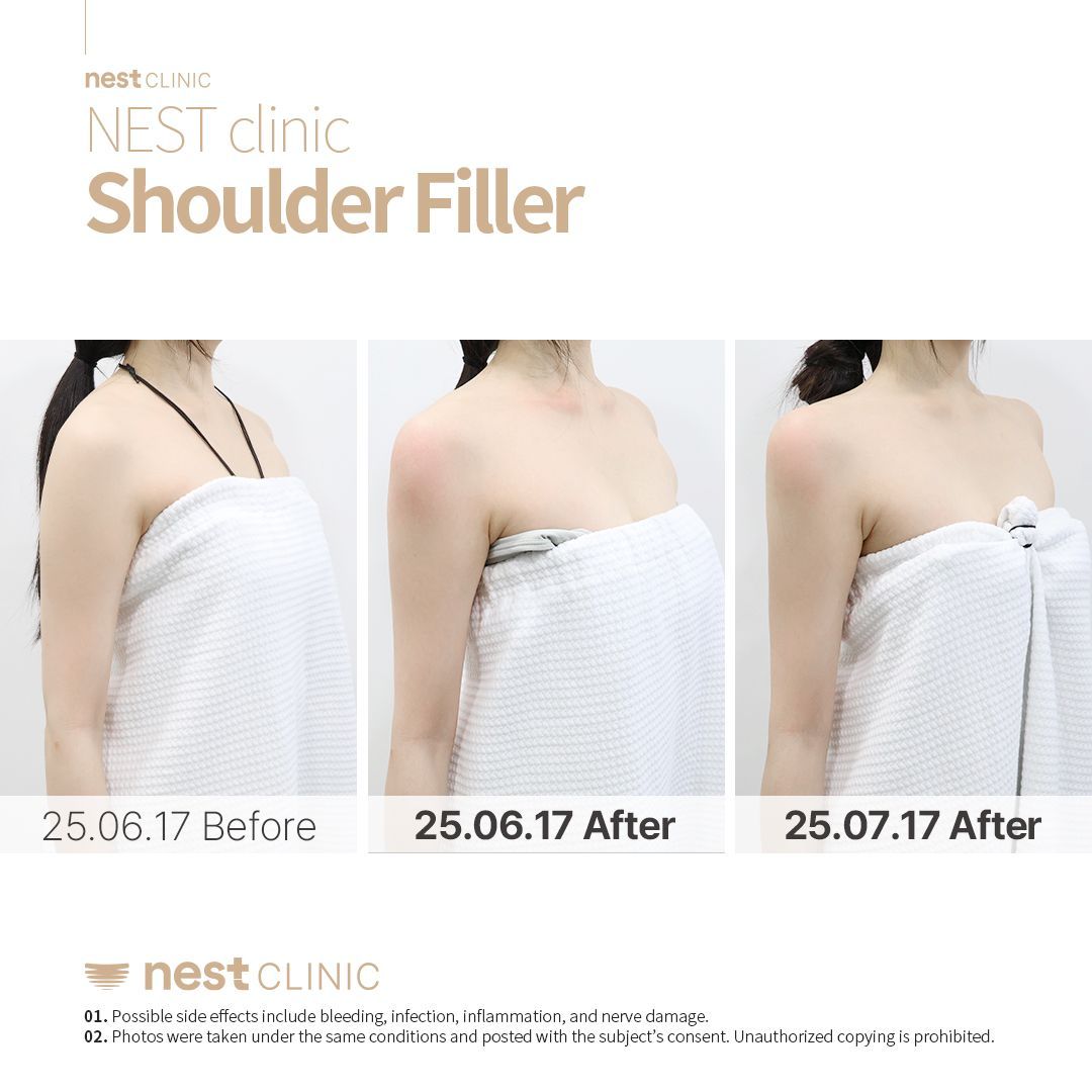Shoulder Filler before and after — Nest Clinic Gangnam, patient 23
