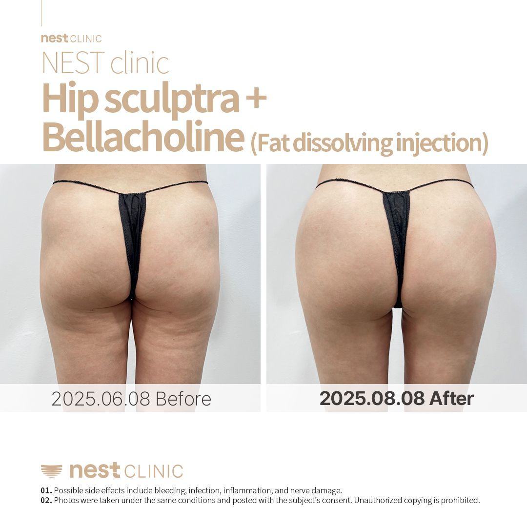 Hip Dip Filler before and after — Nest Clinic Gangnam, patient 9