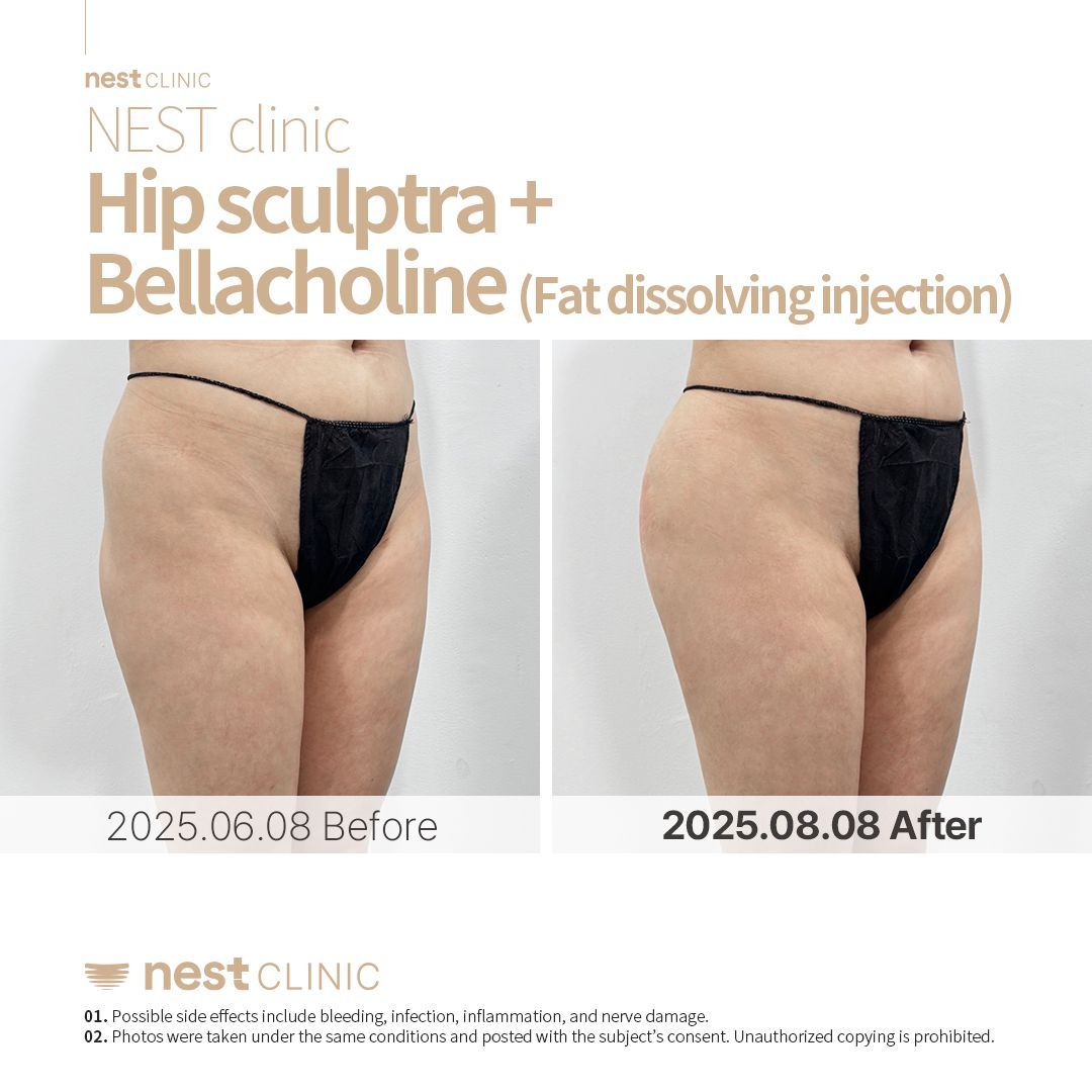 Hip Dip Filler before and after — Nest Clinic Gangnam, patient 7