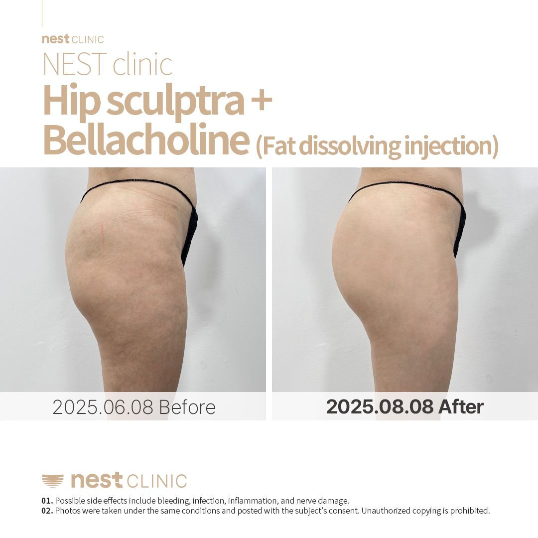 Hip Dip Filler before and after — Nest Clinic Gangnam, patient 8