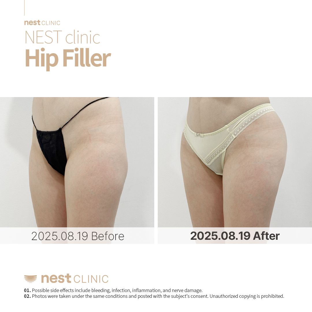 Hip Dip Filler before and after — Nest Clinic Gangnam, patient 10