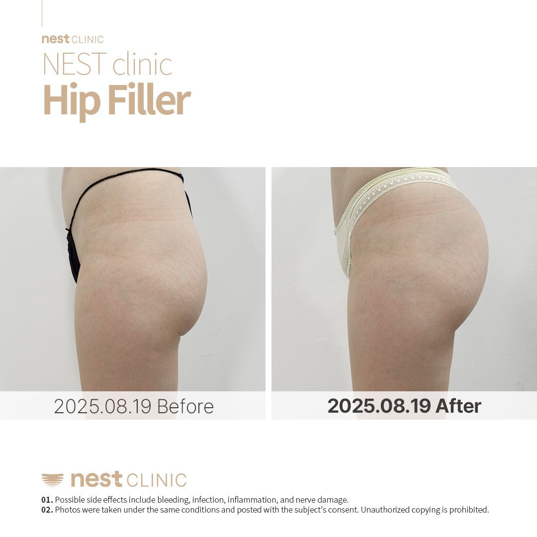 Hip Dip Filler before and after — Nest Clinic Gangnam, patient 11