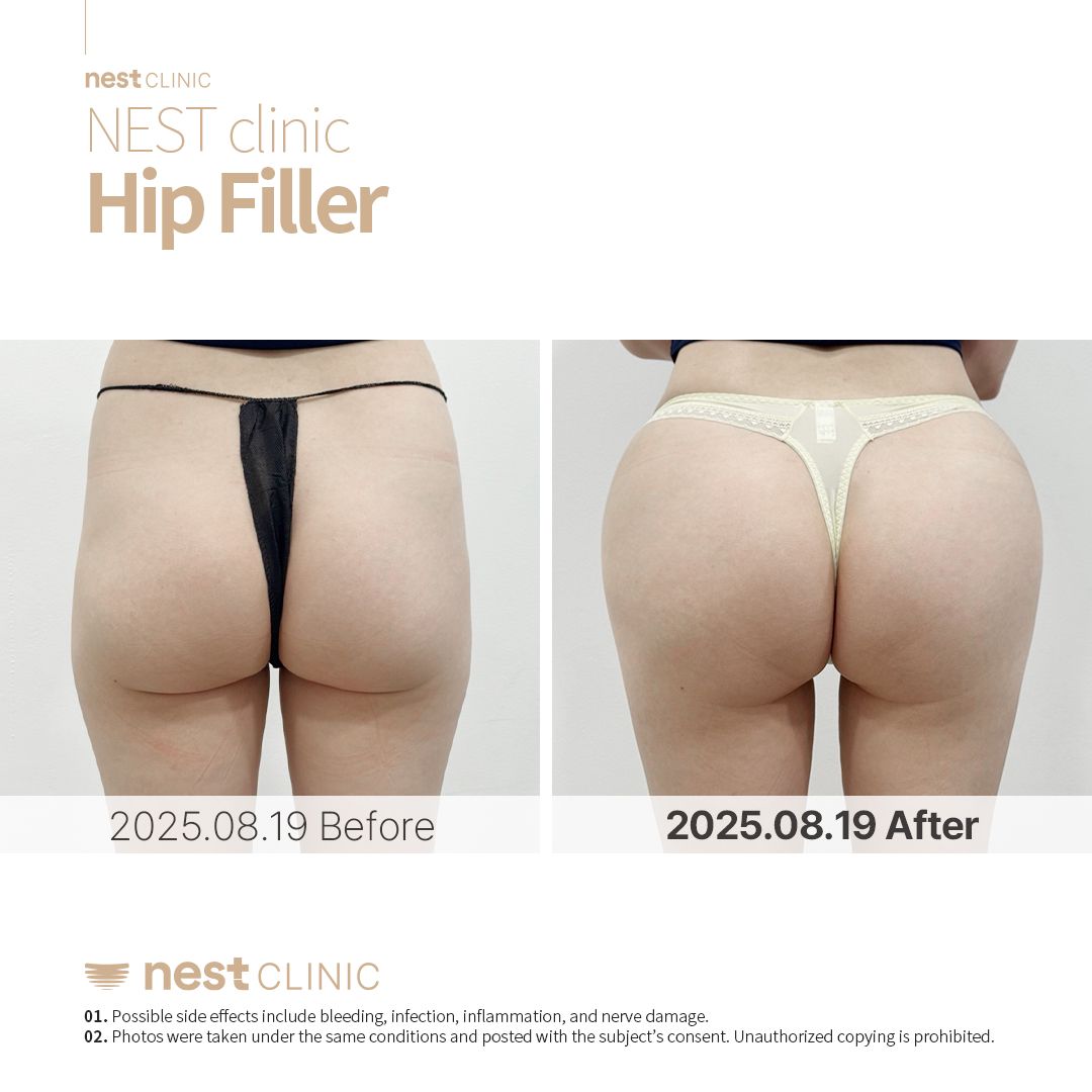 Hip Dip Filler before and after — Nest Clinic Gangnam, patient 12