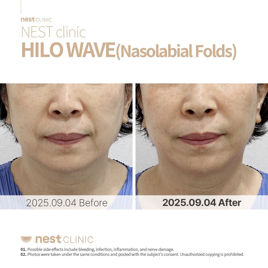 Nasolabial Fold before and after — Nest Clinic Gangnam, patient 2