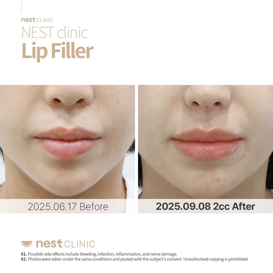 Lip Filler before and after — Nest Clinic Gangnam, patient 17