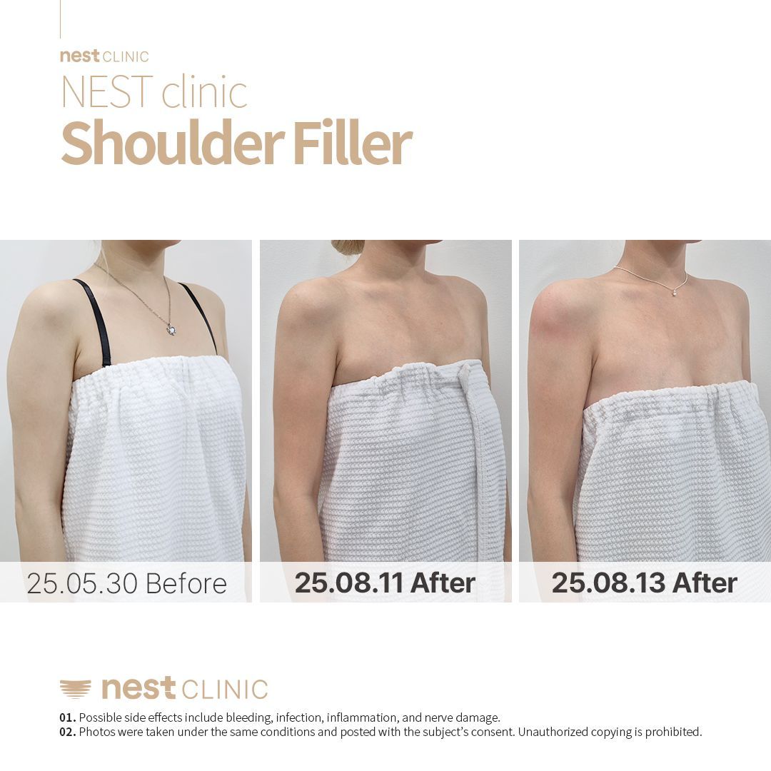 Shoulder Filler before and after — Nest Clinic Gangnam, patient 27