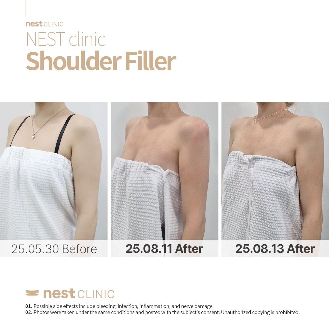 Shoulder Filler before and after — Nest Clinic Gangnam, patient 26