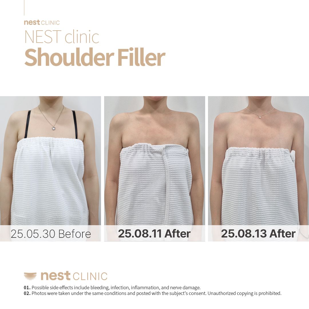 Shoulder Filler before and after — Nest Clinic Gangnam, patient 28
