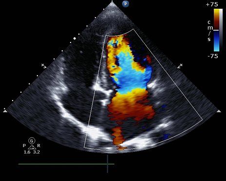 ecocolordoppler