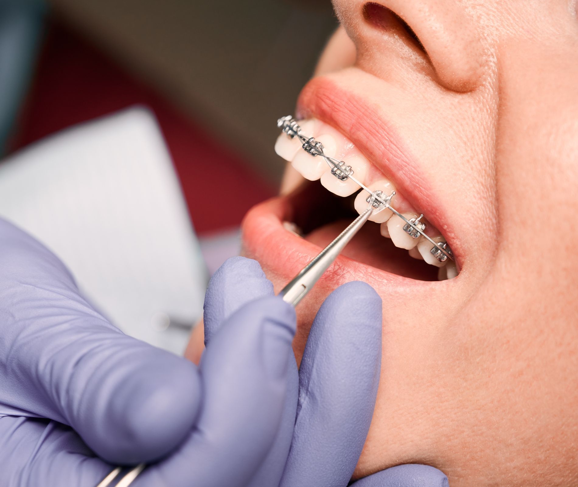 ragazza con apparecchio ai denti