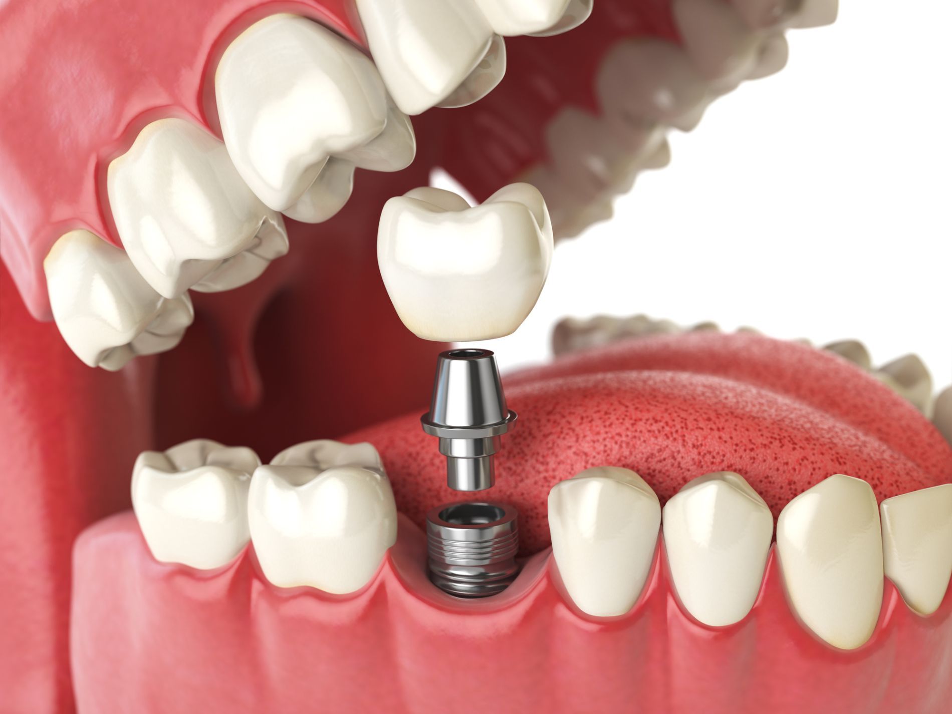 implantologia dentale