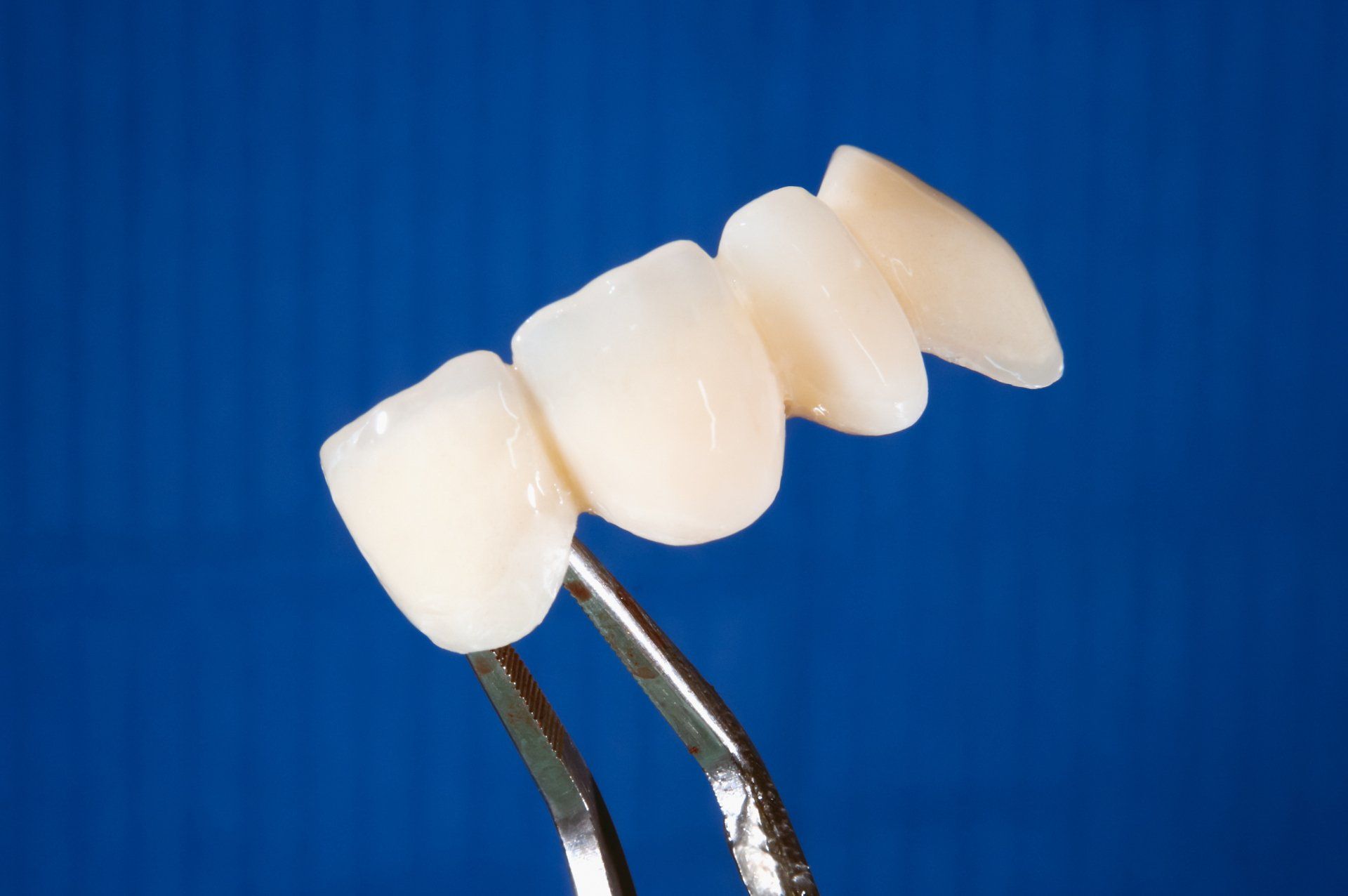 Dental Crown Demonstration — La Crosse, WI — Coulee Family Dental Dental Crown Demonstration — La Crosse, WI — Coulee Family Dental