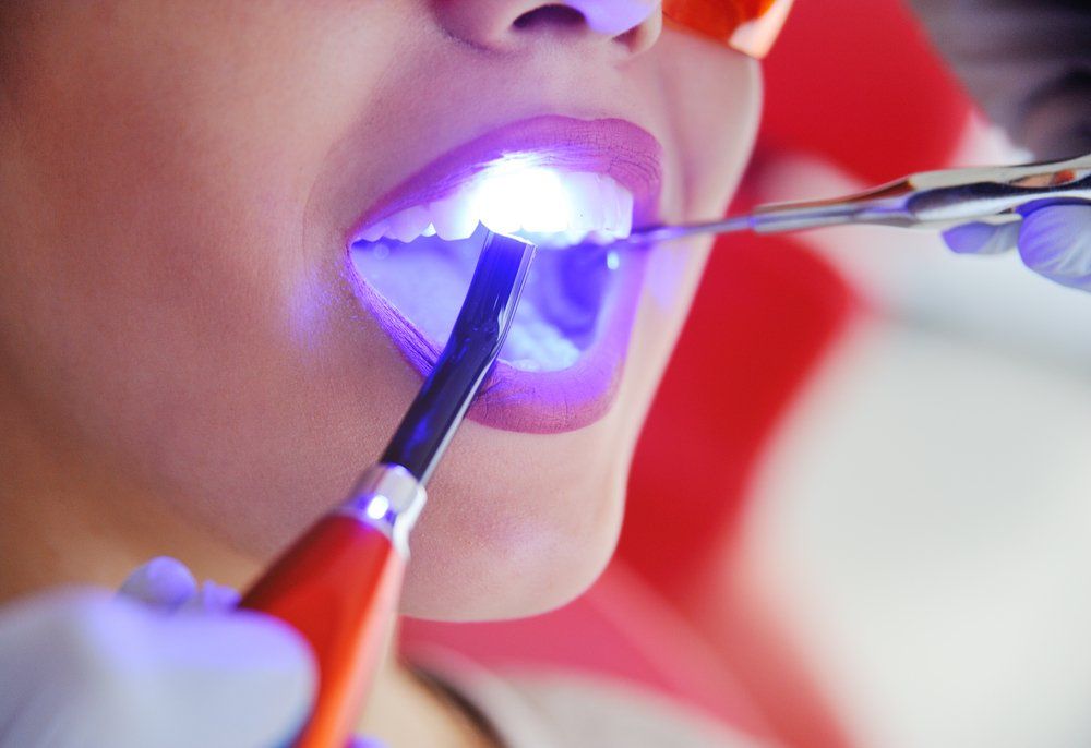 Un dentiste utilise une lampe à polymériser sur les dents d'un patient.