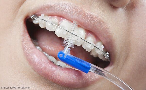 Reinigung der Zähne und Brackets mit einer sog. Ortho-Bürste