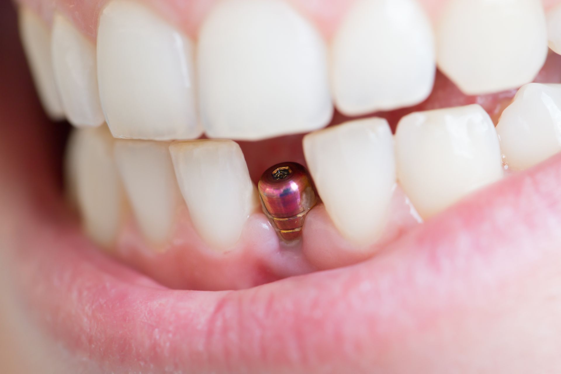 Root Canal Procedure