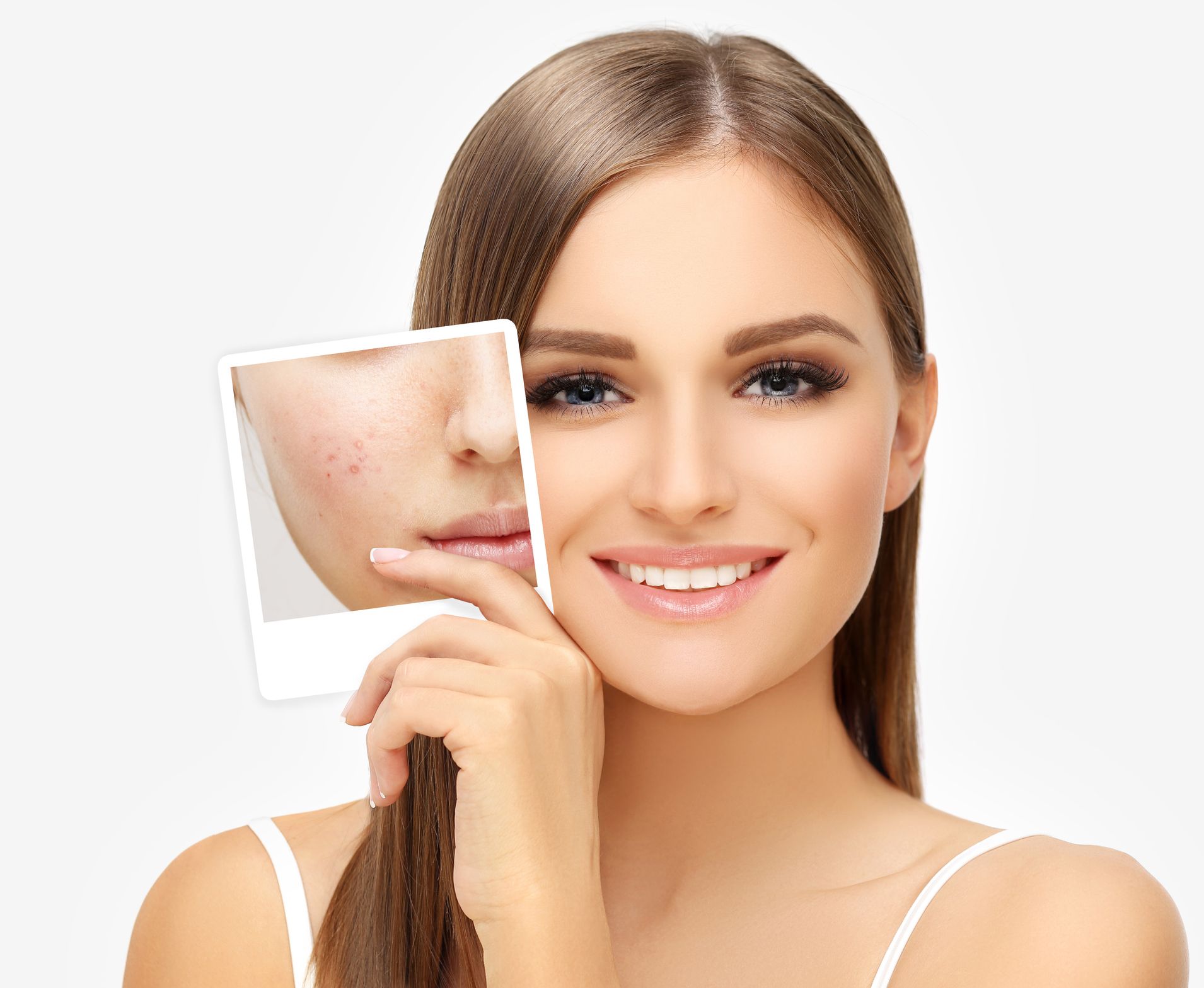 A woman is holding a picture of her face with acne. A woman is holding a picture of her face with acne.