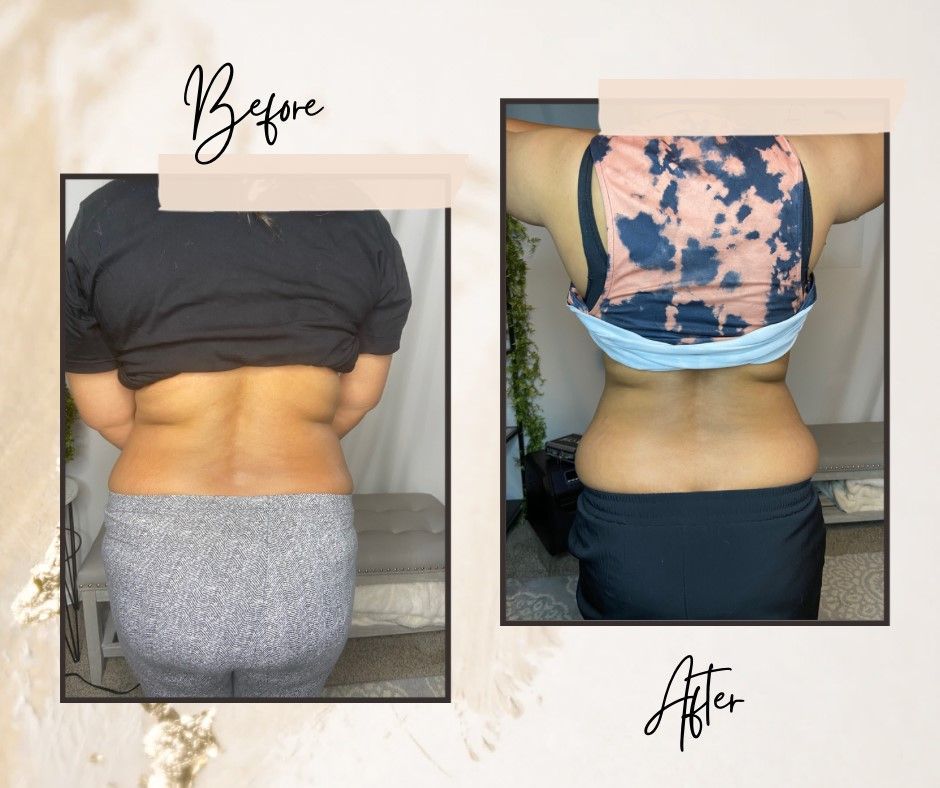 Before and after back view, showing a reduction in fat after a treatment.