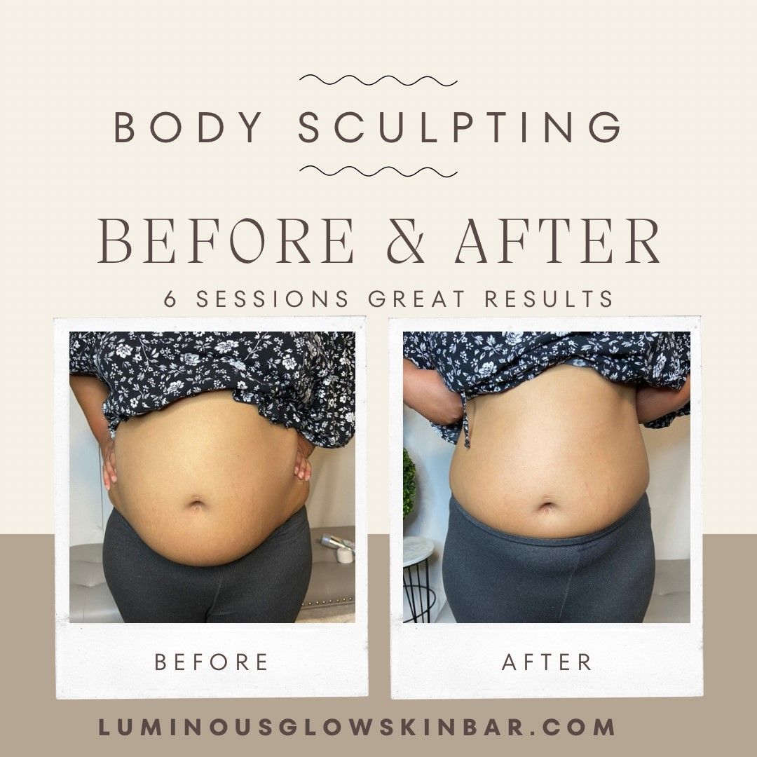 Body sculpting before & after: Abdomen, 6 sessions. Reduction in size.
