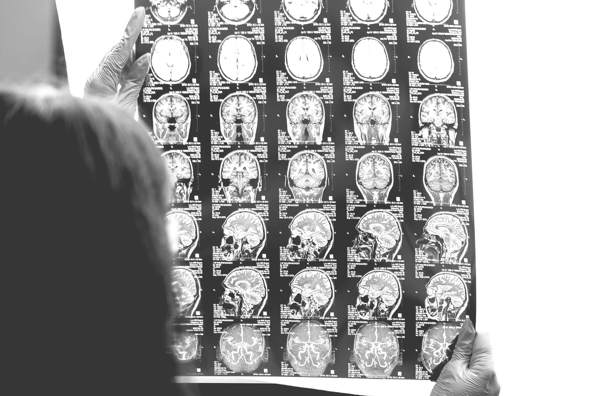 Person holds up a black-and-white brain scan sheet with many images.