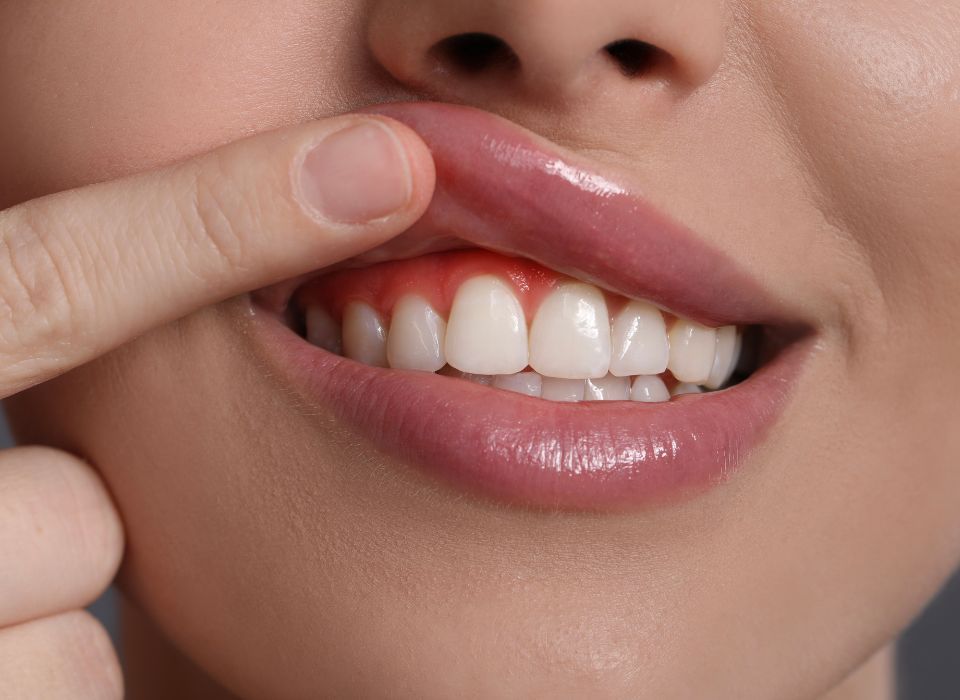 Close-up of a smiling mouth with a finger lifting the upper lip, showing white teeth and red gums.