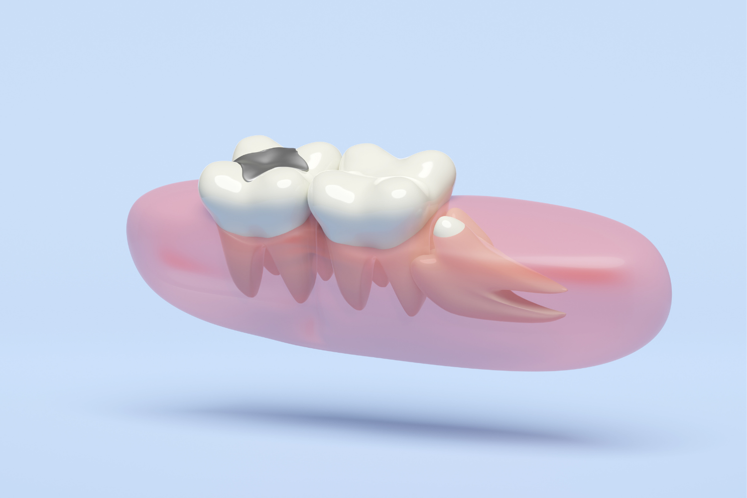 3D rendering of two dental crowns on a pink gum model