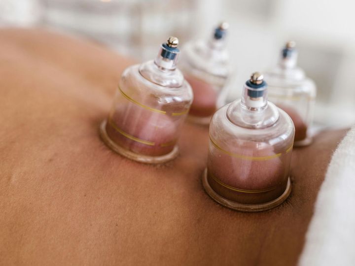 Cupping therapy