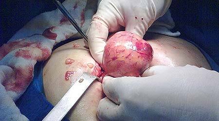 DR EFRAÍN S VARGAS TAPIA - APENDICITIS