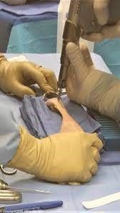 A surgeon is using a machine to cut a hole in a patient 's arm.