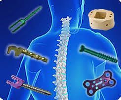 a blue silhouette of a person 's back with various types of spinal implants .