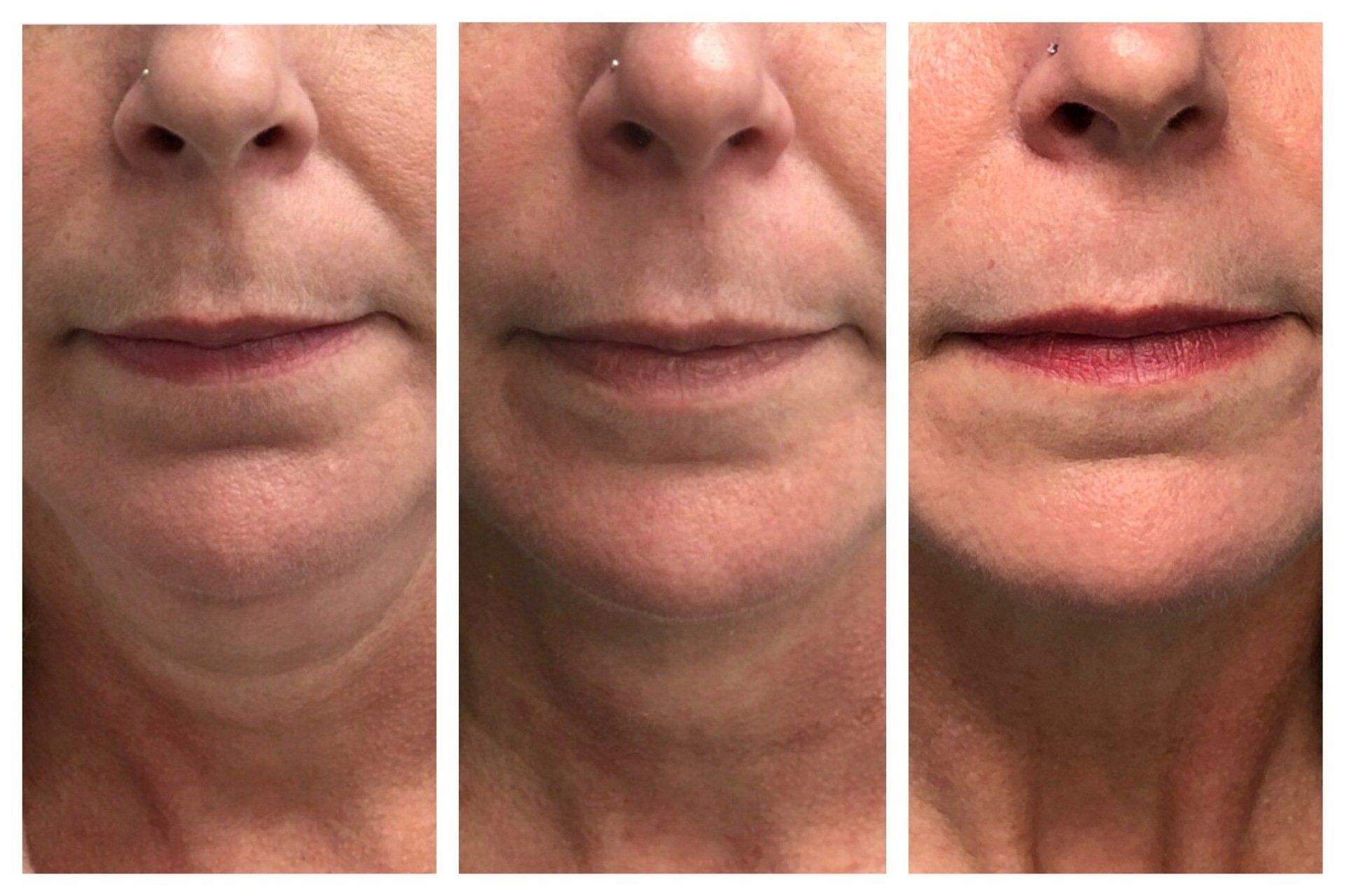 Belkyra Before and After - Real Client Muskoka Belkyra Before and After - Real Client Muskoka