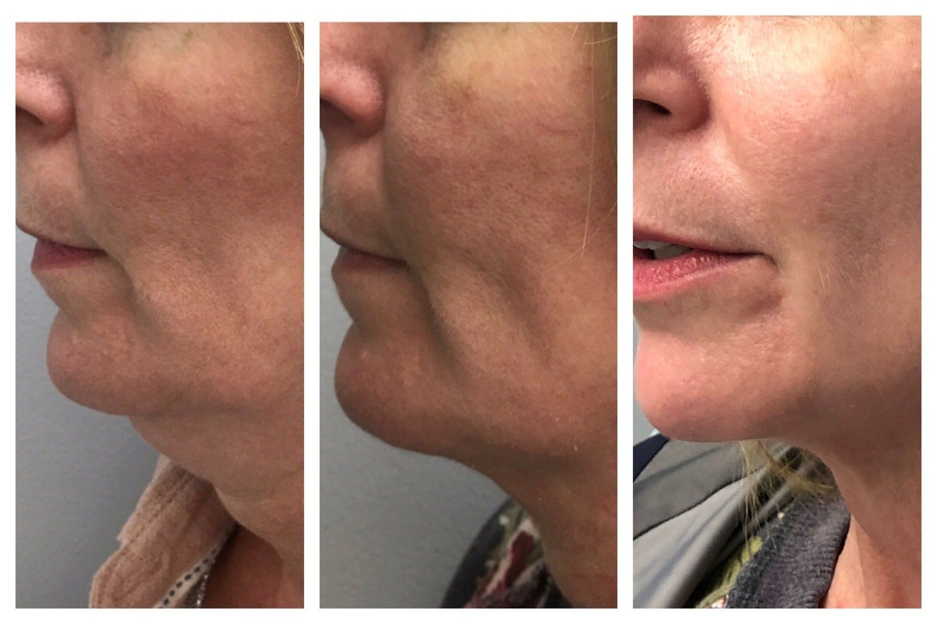 Belkyra Before and After - Real Client Durham Belkyra Before and After - Real Client Durham