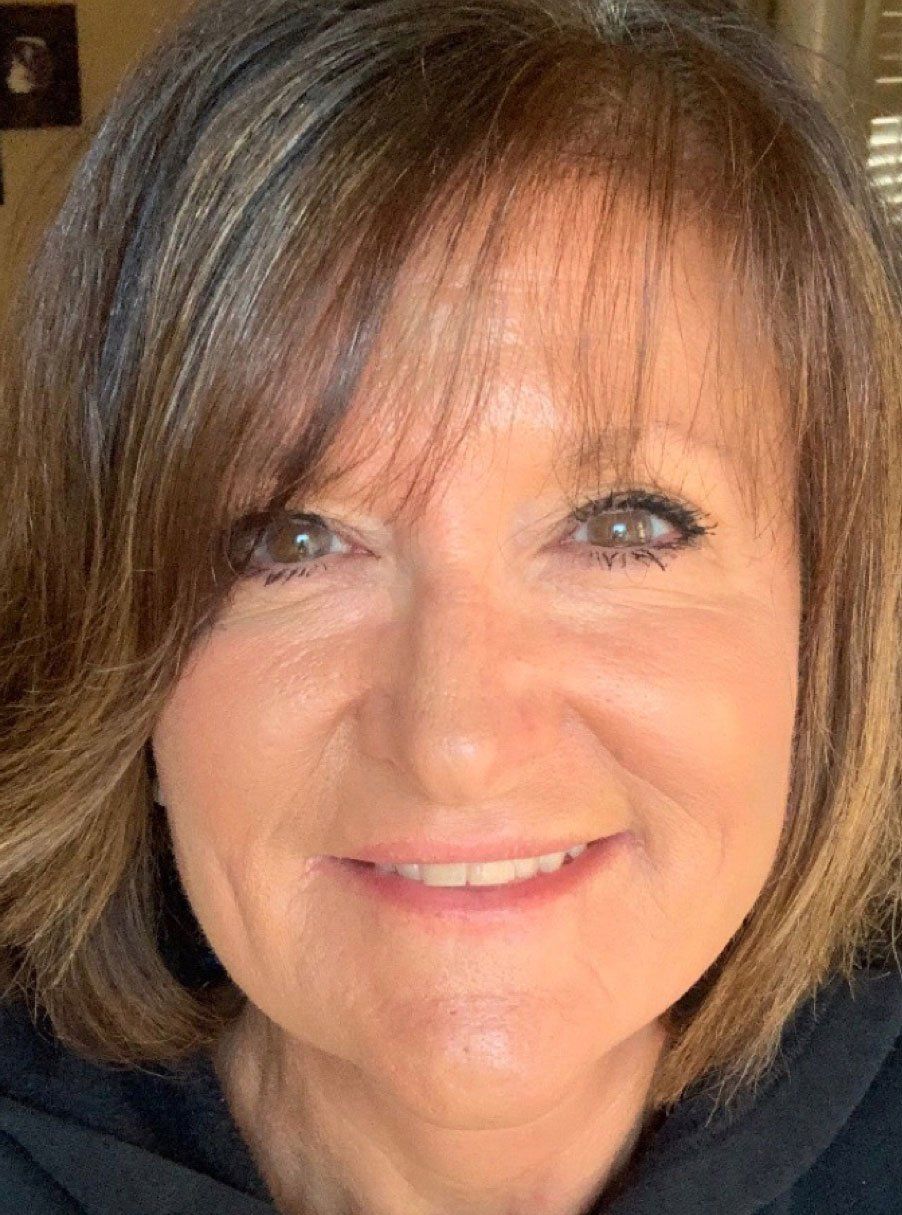 Dermal Fillers After - Real Client Port Carling