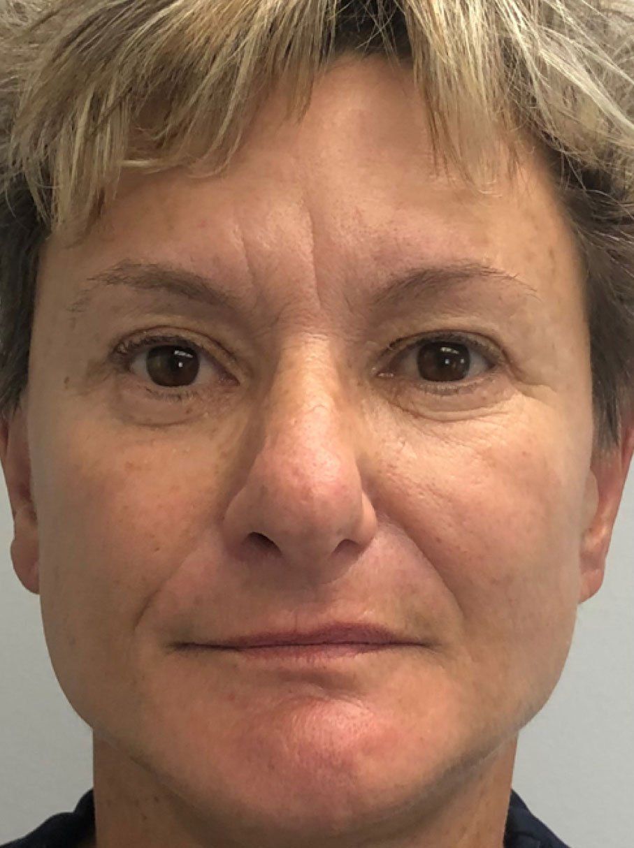 Dermal Fillers After - Real Client Muskoka