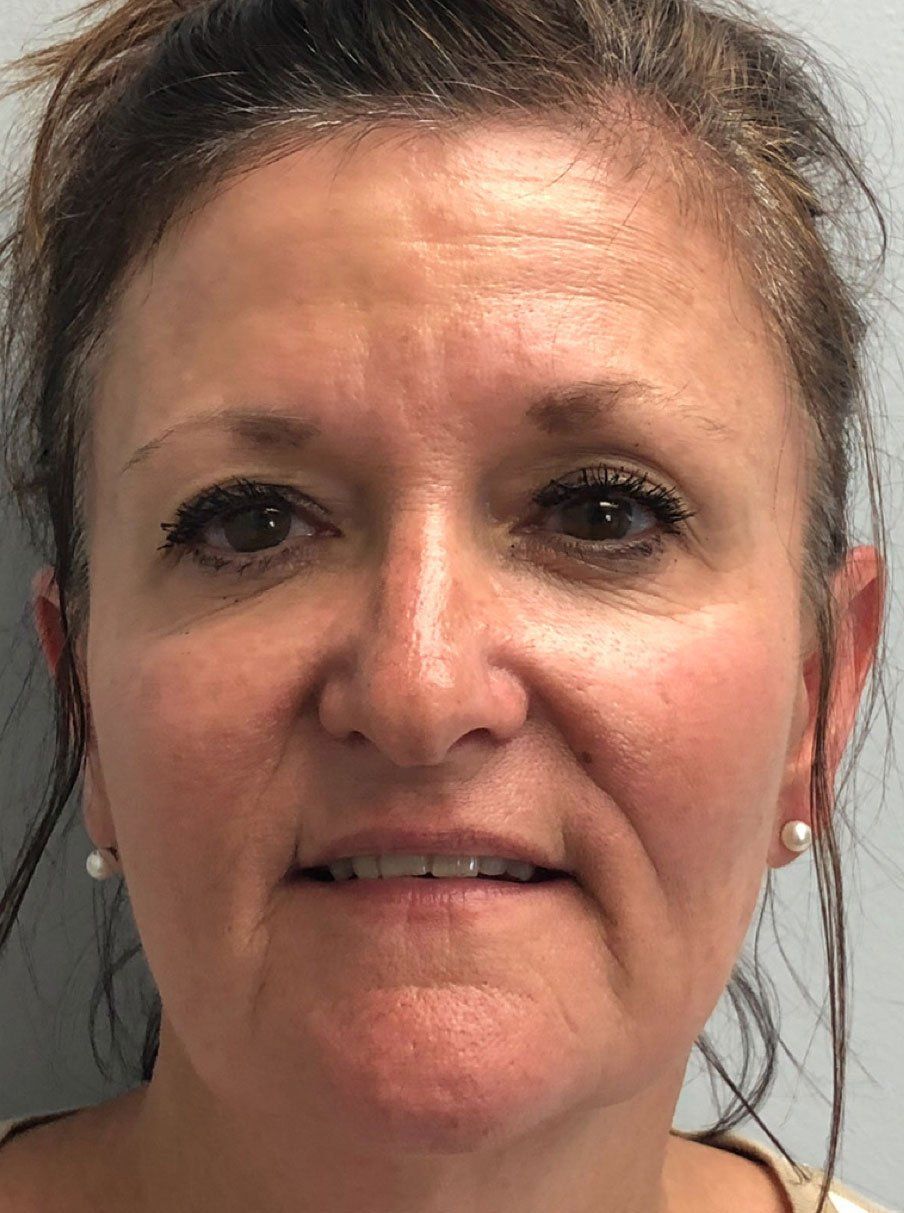 Dermal Fillers Before - Real Client Port Carling